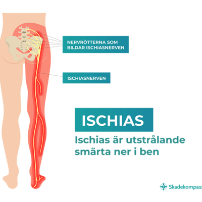 Ischias - smärta ner i ben